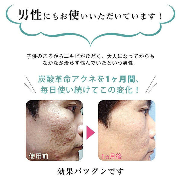 Tansan Kakumei Acne Carbonic Acid Face Treatment 1 Set